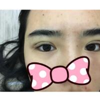 埋線雙眼皮恢復(fù)日志多對比圖分享