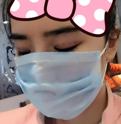 埋線雙眼皮恢復(fù)日志多對比圖分享