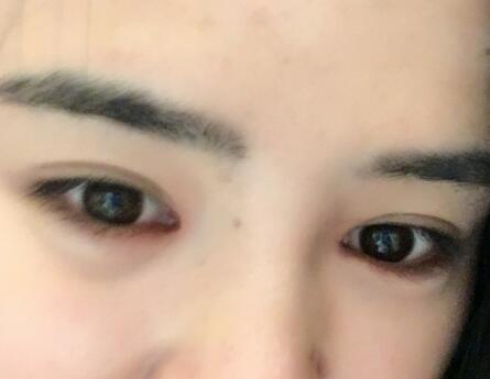 埋線雙眼皮恢復(fù)日志多對比圖分享
