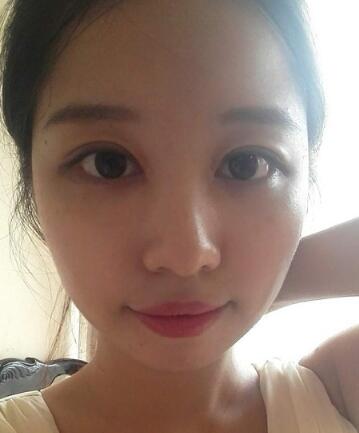 見證全切雙眼皮使單眼皮變雙眼皮的奇跡~恢復過程圖分享