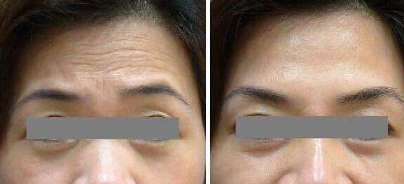 去抬頭紋前后對比圖，去抬頭紋手術(shù)多少錢？