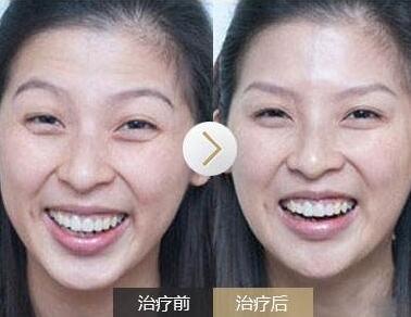 去抬頭紋前后對比圖，去抬頭紋手術(shù)多少錢？