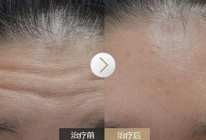 去抬頭紋前后對比圖，去抬頭紋手術(shù)多少錢？