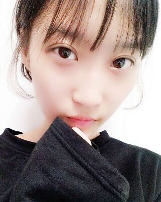 微創(chuàng)全切雙眼皮果對(duì)比照片，貴陽(yáng)麗都葛志鑫手術(shù)案例