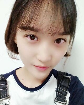 微創(chuàng)全切雙眼皮果對(duì)比照片，貴陽(yáng)麗都葛志鑫手術(shù)案例