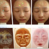 有人做過(guò)光子嫩膚嗎？自己做過(guò)，感覺(jué)果不錯(cuò)分享
