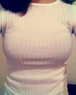 長沙希美假體隆胸前后對比果圖，A到C的變化