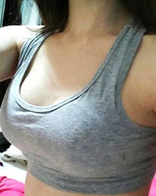 長沙希美假體隆胸前后對比果圖，A到C的變化