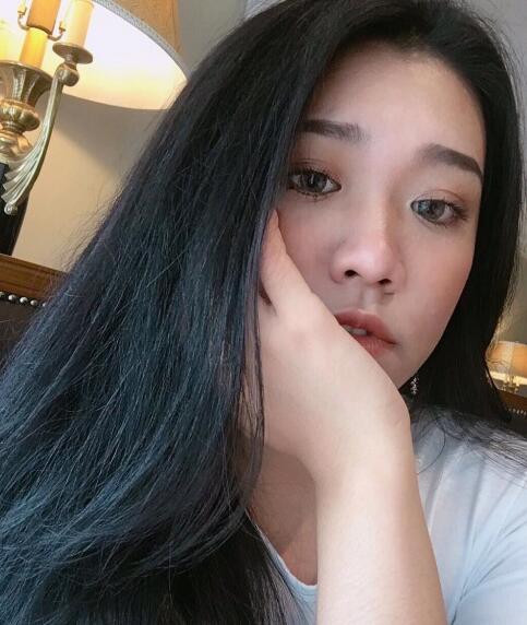 玻尿酸去法令紋前后對(duì)比圖分享