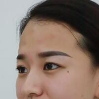 注射瘦臉去抬頭紋眉間紋恢復(fù)過(guò)程圖，真實(shí)案例分享