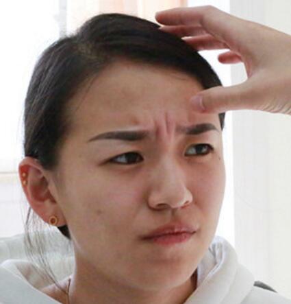 注射瘦臉去抬頭紋眉間紋恢復過程圖，真實案例分享