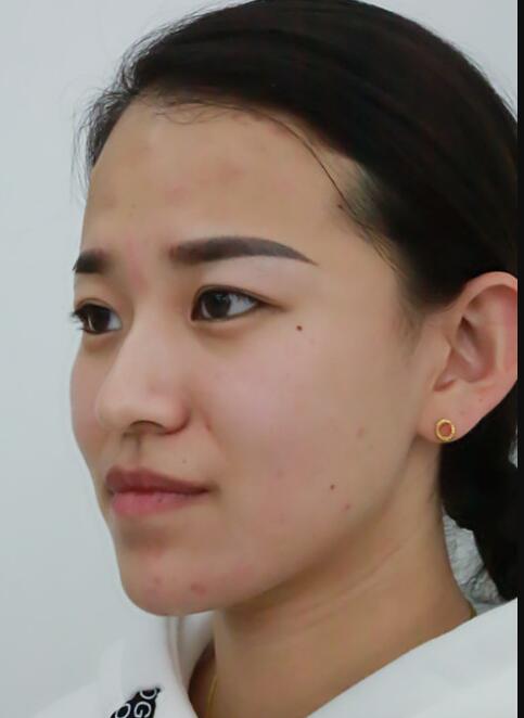 注射瘦臉去抬頭紋眉間紋恢復過程圖，真實案例分享