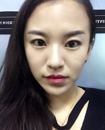 注射瘦臉去抬頭紋眉間紋恢復過程圖，真實案例分享