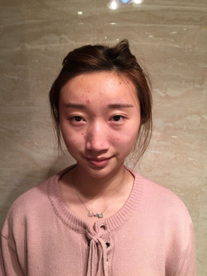 濰坊華美童艷梅醫(yī)生做的面部脂肪填充，大家來看看果怎么樣