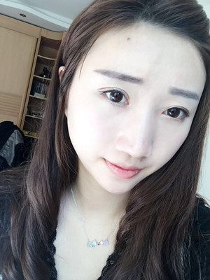 濰坊華美童艷梅醫(yī)生做的面部脂肪填充，大家來看看果怎么樣