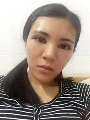 青?？等A馬晶醫(yī)生切開(kāi)雙眼皮真實(shí)案例分享