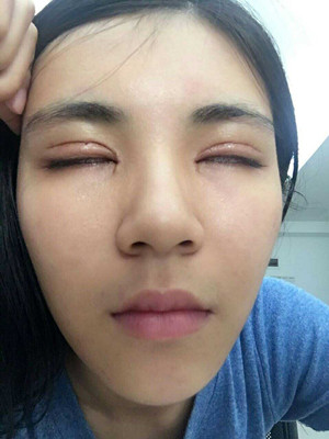 青?？等A馬晶醫(yī)生切開(kāi)雙眼皮真實(shí)案例分享