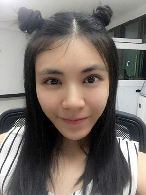 青?？等A馬晶醫(yī)生切開(kāi)雙眼皮真實(shí)案例分享