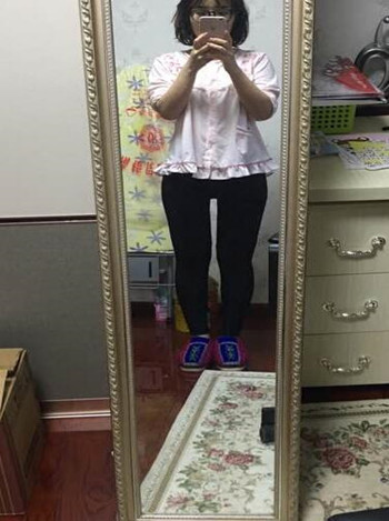 廣州美萊羅延平做的大腿環(huán)吸整形恢復(fù)果過(guò)程案例