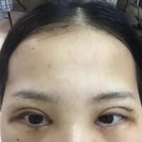 切開雙眼皮+開眼角前后對(duì)比圖和恢復(fù)過程分享