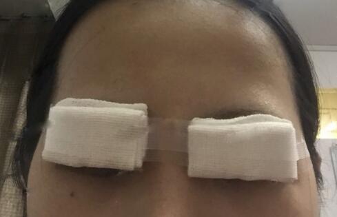 切開雙眼皮+開眼角前后對比圖和恢復過程分享