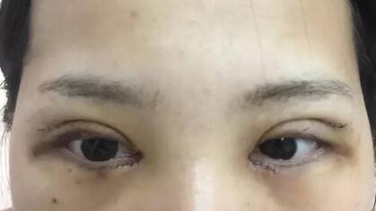 切開雙眼皮+開眼角前后對比圖和恢復過程分享