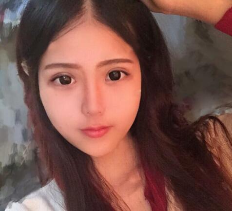 切開雙眼皮+開眼角前后對比圖和恢復過程分享