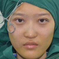 切開雙眼皮多少錢？割雙眼皮真實(shí)案例多對(duì)比圖分享