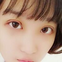 切開雙眼皮多少錢？割雙眼皮真實(shí)案例多對(duì)比圖分享