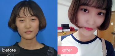 切開雙眼皮多少錢？割雙眼皮真實案例多對比圖分享