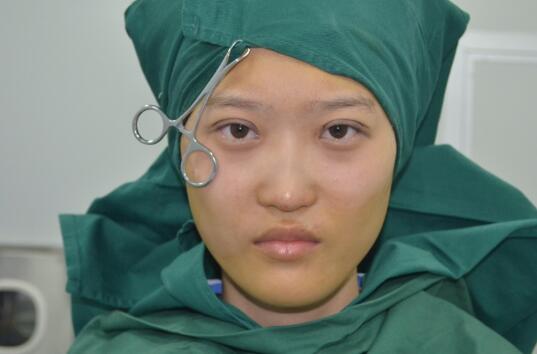 切開雙眼皮多少錢？割雙眼皮真實案例多對比圖分享