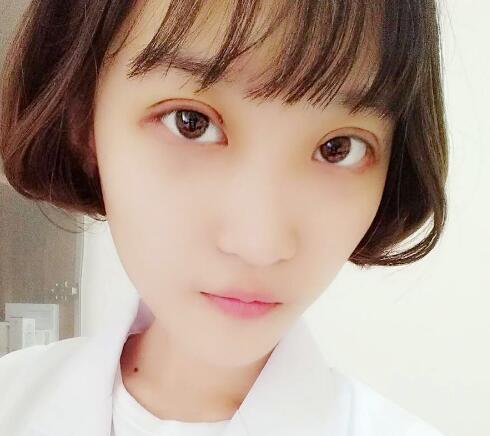 切開雙眼皮多少錢？割雙眼皮真實案例多對比圖分享