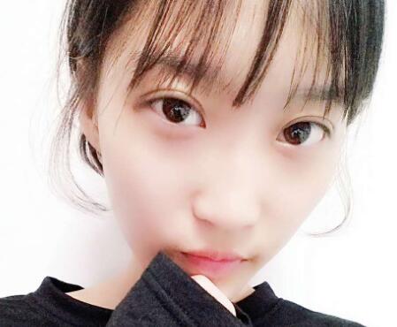 切開雙眼皮多少錢？割雙眼皮真實案例多對比圖分享