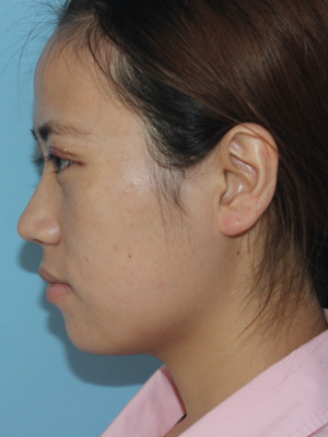 濟(jì)南海峽謝燕燕做的切開雙眼皮，分享前后對(duì)比照片以及恢復(fù)過(guò)程