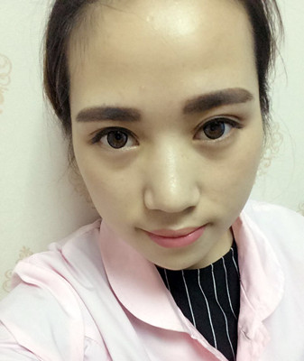 濟(jì)南海峽謝燕燕做的切開雙眼皮，分享前后對(duì)比照片以及恢復(fù)過(guò)程