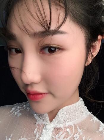 成都蜀尚蓉雅割雙眼皮+開眼角真實(shí)案例