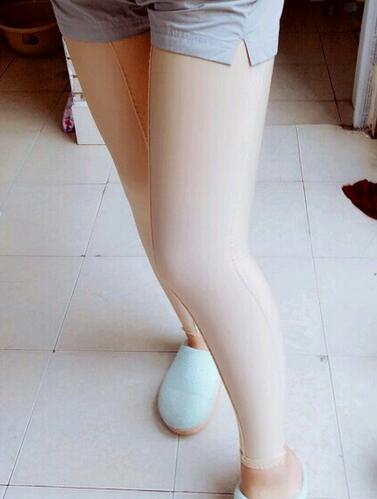 武漢詮美大腿吸脂后恢復(fù)過程