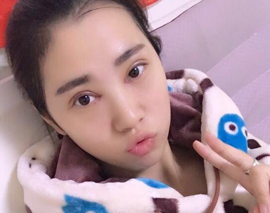 開(kāi)眼角+割雙眼皮真實(shí)案例前后對(duì)比圖分享——四川悅好整形