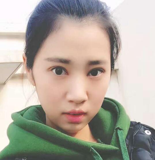 開(kāi)眼角+割雙眼皮真實(shí)案例前后對(duì)比圖分享——四川悅好整形