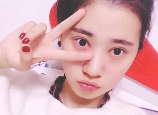 開(kāi)眼角+割雙眼皮真實(shí)案例前后對(duì)比圖分享——四川悅好整形