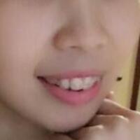 牙齒矯正的適宜年齡，多對(duì)比圖真實(shí)案例分享——成都格林口