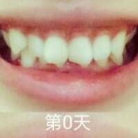 成人牙齒矯正費(fèi)用9800元——成都格林口腔醫(yī)院