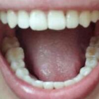 成人牙齒矯正費(fèi)用9800元——成都格林口腔醫(yī)院