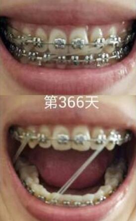 牙齒矯正前后對(duì)比圖，成人牙齒矯正費(fèi)用9800元——成都格林口腔醫(yī)院