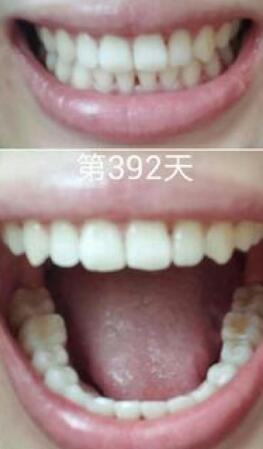 牙齒矯正前后對(duì)比圖，成人牙齒矯正費(fèi)用9800元——成都格林口腔醫(yī)院