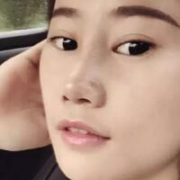 假體隆鼻恢復(fù)時(shí)間2個(gè)月真實(shí)案例分享——成都魅麗經(jīng)緯