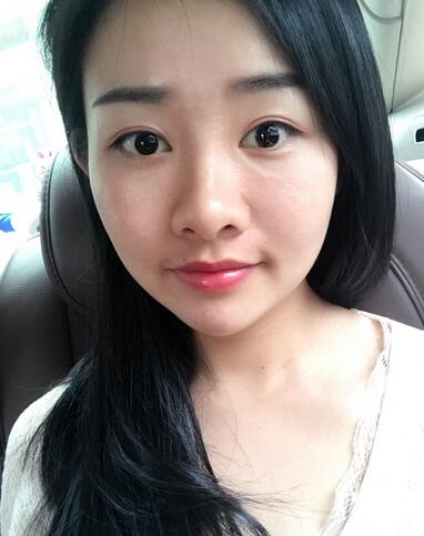 武漢樂美韓式微創(chuàng)雙眼皮+開內(nèi)眼角