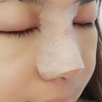 歪鼻子矯正整形恢復(fù)過(guò)程和對(duì)比圖分享——成都魅麗經(jīng)緯醫(yī)療