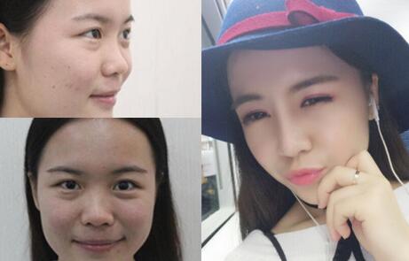 隆鼻整形前后對比圖，歪鼻子矯正整形恢復(fù)過程