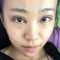 在成都魅麗經(jīng)緯做單眼皮變雙眼皮整形恢復(fù)過程和對比圖分享